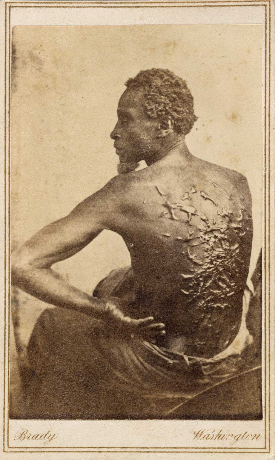 Photograph of a man's badly scarred back