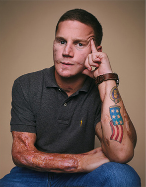 waist length photo of a badly wounded young veteran